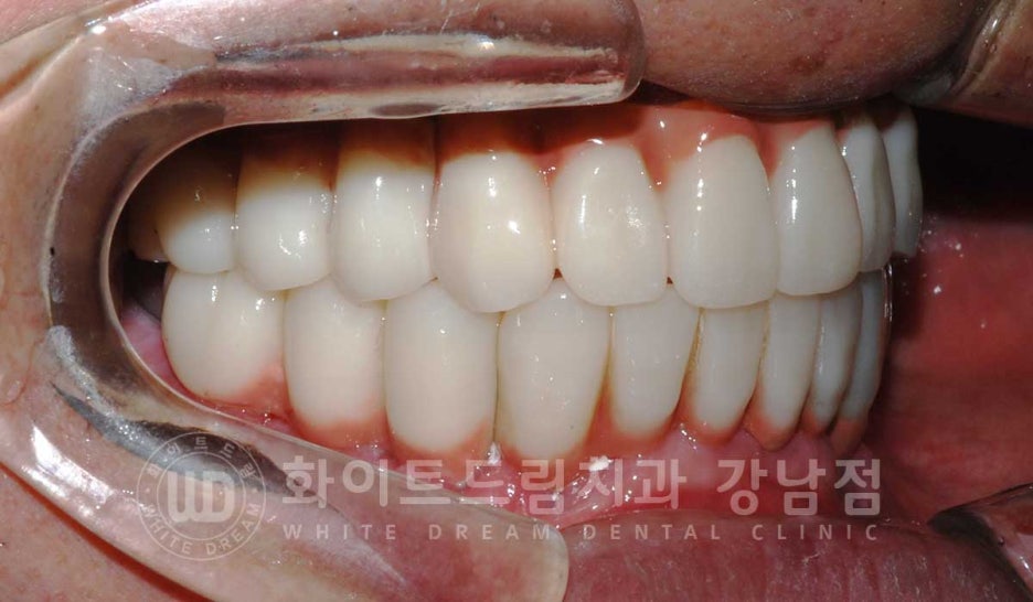 Gangnam Station Dental Clinic Specializing in Implant Revision Surgery—Revision Surgery and Full-Mouth Implant Treatment at the Same Time! image 11
