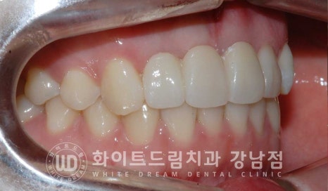 앞니 빠짐 임플란트 / 사고로 인한 앞니 탈구. 앞니 임플란트 치료는? 관련 이미지 16