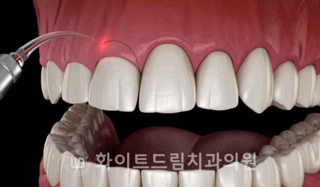 강남역 잇몸성형, 라미네이트와 흔히 동반되는 관련 이미지 6