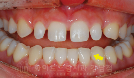 강남 벌어진앞니 교정 / "심하게 벌어진 치아, 어떻게?" 부분교정 + 라미네이트로 개선! 관련 이미지 9