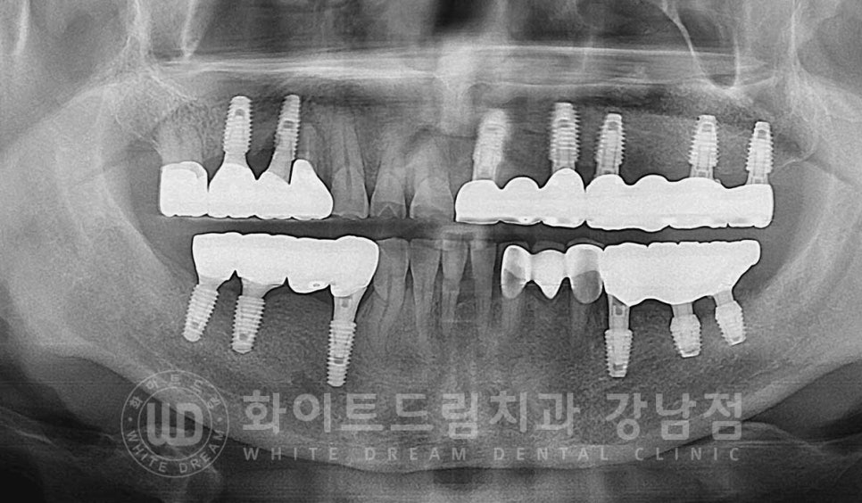 임플란트 재수술의 주원인, "임플란트 주위염과 임플란트 찢어짐!" 관련 이미지 15