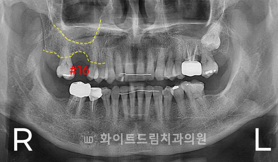 강남역어금니임플란트 치료 시 흔히 동반되는 상악동거상술 (Lateral window 방식), "잘 됐는지 어떻게 확인하죠?" 관련 이미지 5
