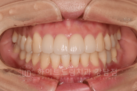 강남 덧니 비발치교정 / 임플란트와 치아교정 동시 진행 case 리뷰. 관련 이미지 25