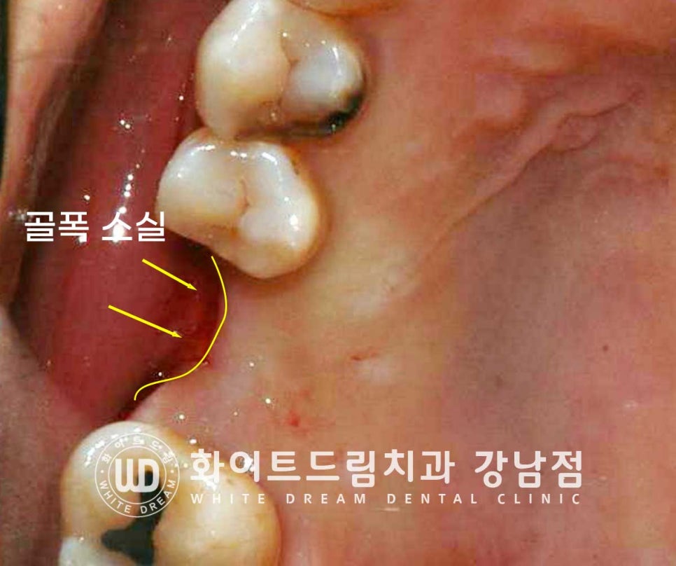 상악 어금니 임플란트 치료 시 동반되는 "상악동 거상술" 이란? 관련 이미지 1