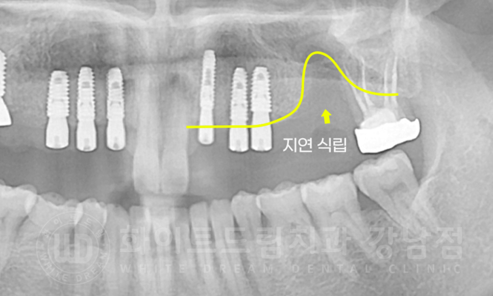 강남역 치과브릿지 "브릿지가 흔들려요" 흔들리는 브릿지 치료는? 관련 이미지 8
