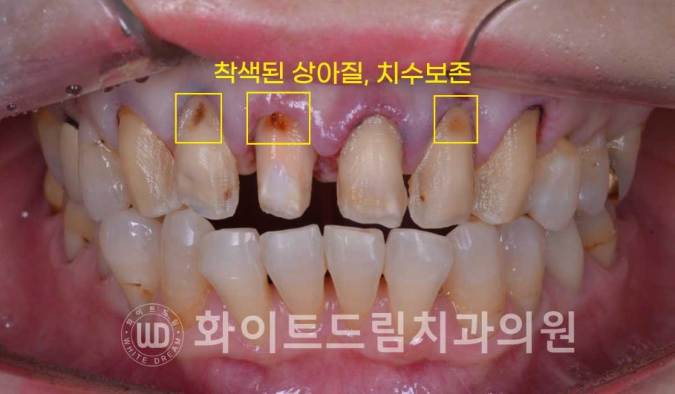 신논현라미네이트, 중년 충치치료, "치경부 우식증, 라미네이트로 당일 치료 OK" 관련 이미지 9
