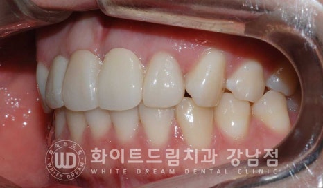 앞니 빠짐 임플란트 / 사고로 인한 앞니 탈구. 앞니 임플란트 치료는? 관련 이미지 14