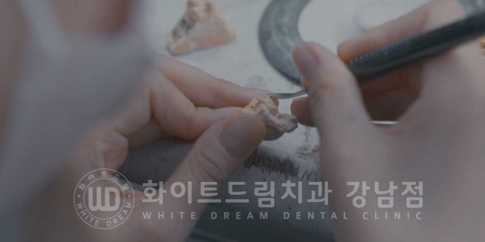 역삼역 왜소치치료 / 치아 하나가 너무 작아요. 왜소치 라미네이트 잘하는 치과 관련 이미지 10