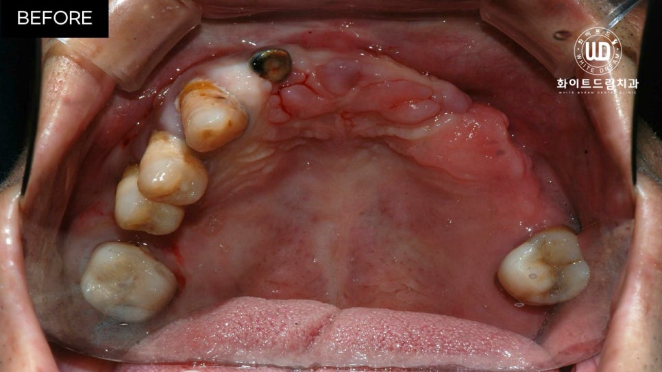 전체임플란트 식립 및 임플란트뼈이식 후기 관련 이미지 1