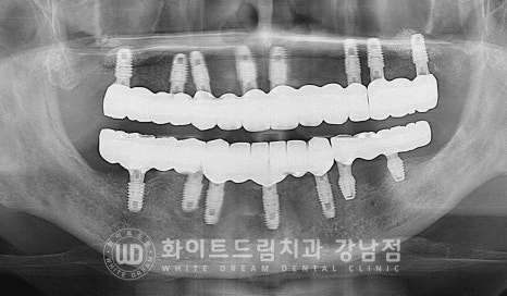 치주염 전체임플란트, 염증으로 인한 상악동 천공 & 신경관 가까이 녹은 잇몸뼈. 임플란트 식립 가능할까? 관련 이미지 15