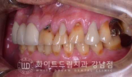 앞니 충치 라미네이트 치료 / "옆 크라운과 치아 색상을 맞추고 싶어요" 관련 이미지 6