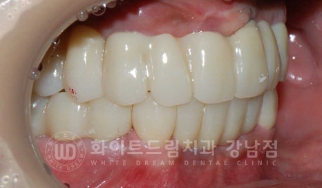 치주염 전체임플란트 치료 사례 / 치아를 흔들리게 만드는 치주염이란? 관련 이미지 16