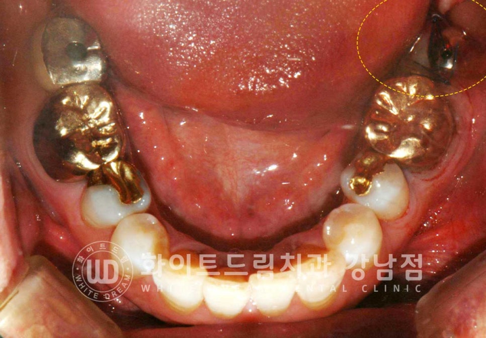 강남역 임플란트재수술 치과 / "임플란트가 흔들려요!" 임플란트 주위염 관련 이미지 10
