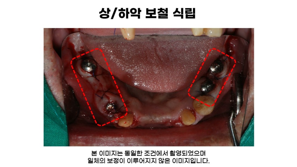 60대 전악임플란트후기 및 치료기간 관련 이미지 5