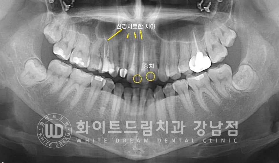 신경치료 후 크라운을 씌워야 하는 이유 & 신경치료 후 변색 치료 Case 리뷰 관련 이미지 5