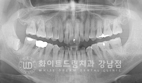사고당한 앞니치료, "흔들리고 점점 변색돼요." 앞니 임플란트 & 신경치료 관련 이미지 14