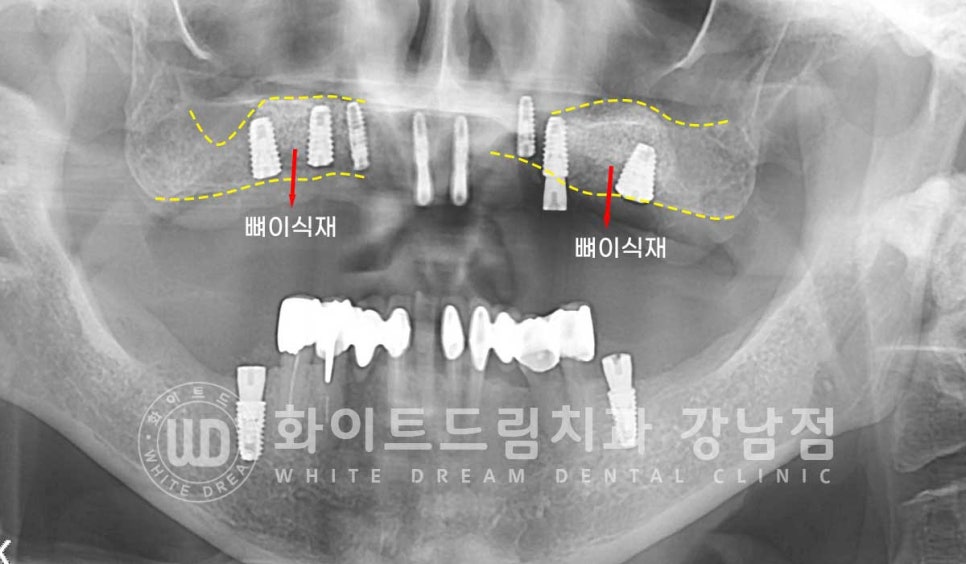 상악 풀케이스임플란트 사례 "부산에서 강남까지 왔어요" 관련 이미지 11