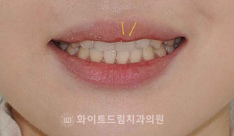 강남역앞니치과 / "신경치료한 치아가 누렇게 변했어요." 신경치료 후 변색된 치아, 어떻게 치료하나요? 관련 이미지 14