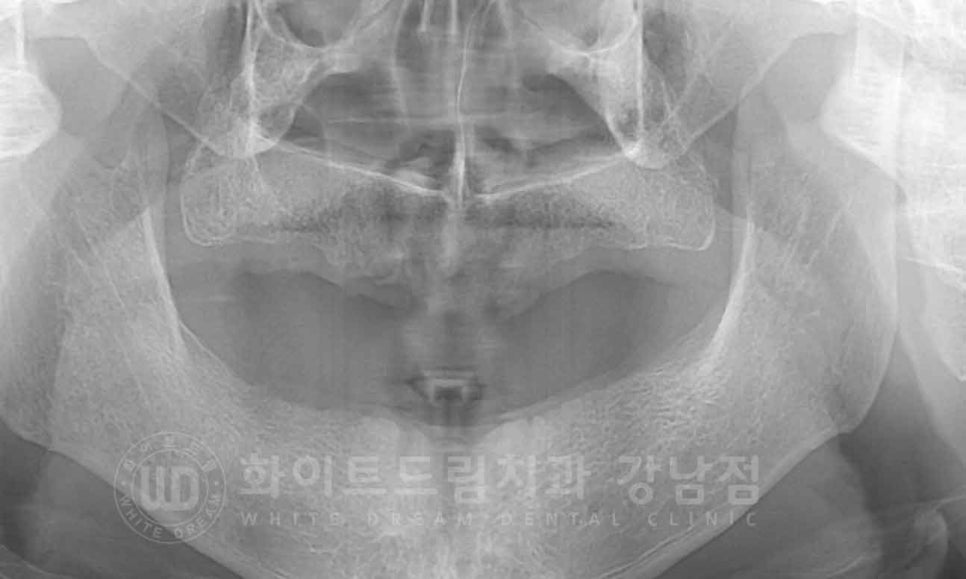 강남역 전악 임플란트 "치아가 흔들리고 빠져요!" 치주염 임플란트 치료 관련 이미지 6