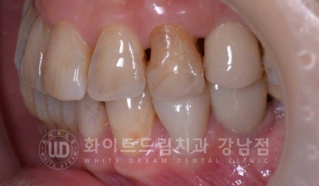 노화된 치아 라미네이트 / 치아미백을 해도 하얘지지 않는 마모된 치아는 어떻게 할까? 관련 이미지 10