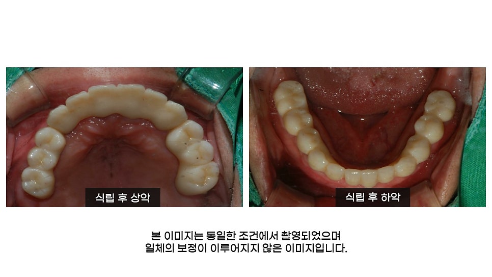 40대임플란트식립후기 및 어금니임플란트 가격, 종류 알아보기 위해 관련 이미지 11