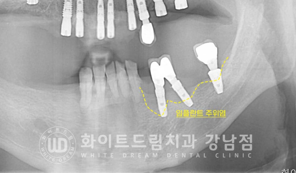 강남역 전악임플란트치과 / 치주 질환이 치아와 임플란트에 끼치는 영향! 관련 이미지 16