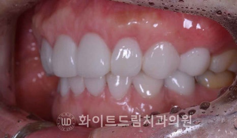 강남옹니라미네이트 "치아가 안으로 들어가서 할머니처럼 보여요" 경미 & 중증도 옹니 라미네이트 치료 관련 이미지 6