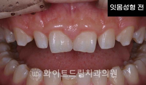 강남역 잇몸성형, 라미네이트와 흔히 동반되는 관련 이미지 7