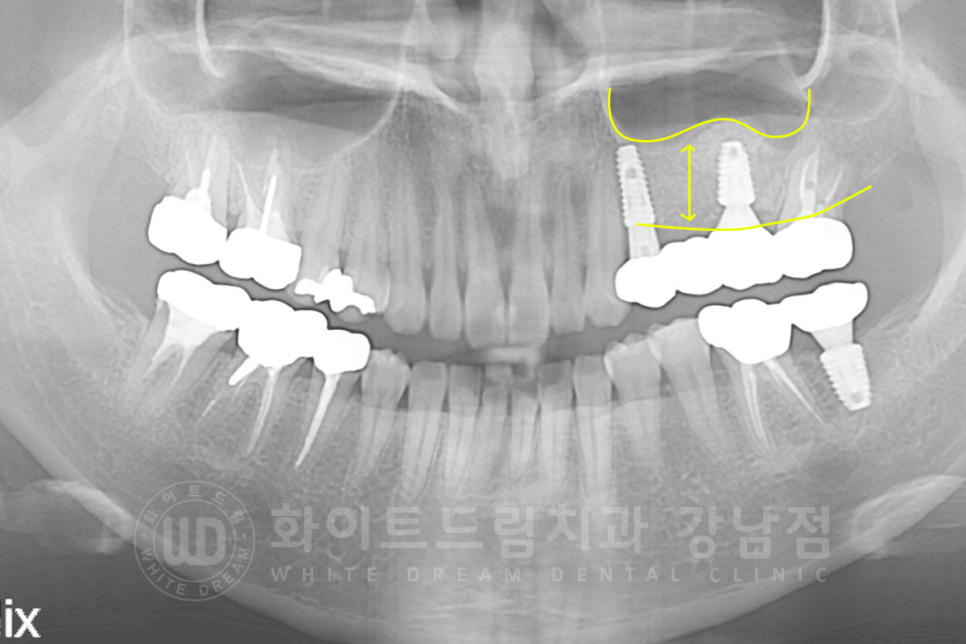 강남역 어금니 임플란트 "어금니가 부러졌어요" 상악동 거상술(lateral approach) 관련 이미지 10