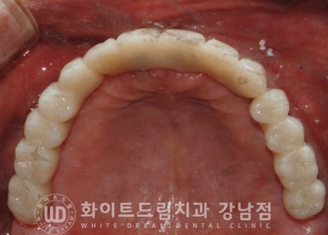 전체 임플란트 치료 기간과 수술 후 나타나는 변화는? 관련 이미지 15