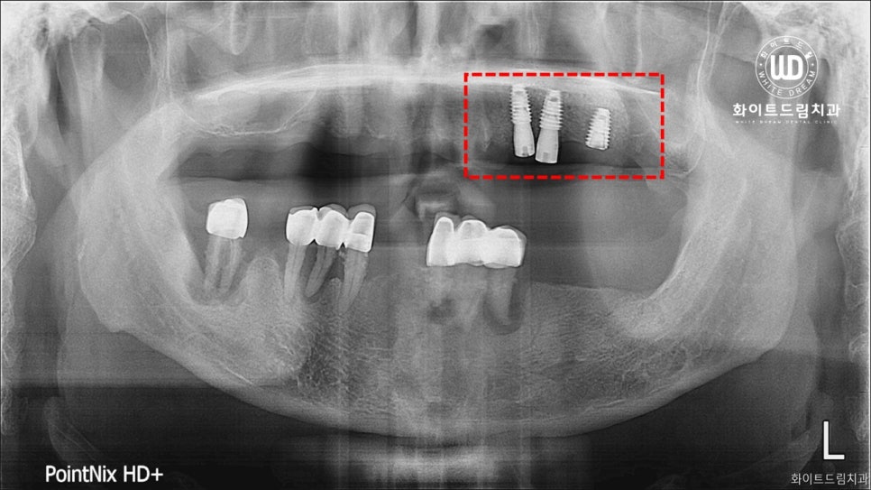 무너진 잇몸뼈와 치아 상실을 대체하는 전악임플란트 치료 사례 관련 이미지 3