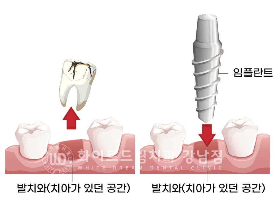 발치 즉시 임플란트 "내원 당일 발치 후 바로 임플란트 식립!" 관련 이미지 2