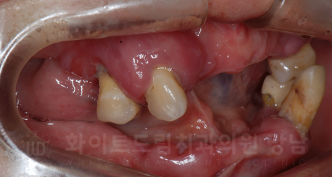 강남역 임플란트 치과 "틀니가 안 맞아서 불편해요" 틀니 → 전체 임플란트로! 관련 이미지 5