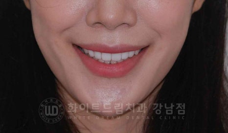 강남역 나비앞니 라미네이트 / "투명교정과 라미네이트 치료" 강남역 화이트드림치과 관련 이미지 14