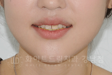 강남역 주변 치과 "10년 된 앞니가 변색됐어요" 앞니 심미 치료 관련 이미지 10
