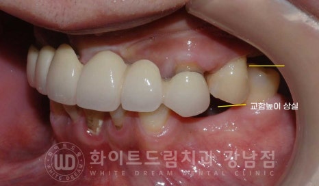 치주염 전체임플란트 치료 사례 / 치아를 흔들리게 만드는 치주염이란? 관련 이미지 10