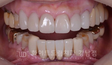 중년 앞니라미네이트 / 노화로 마모되고 누렇게 변한 치아, 어떻게 치료할까? 관련 이미지 17
