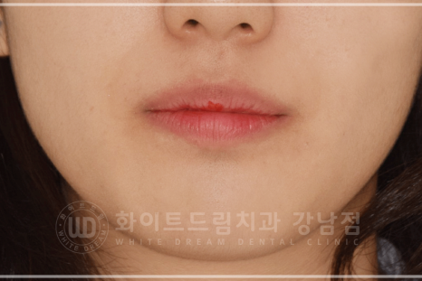 강남 덧니 비발치교정 / 임플란트와 치아교정 동시 진행 case 리뷰. 관련 이미지 27