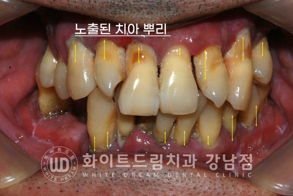 강남역 전악임플란트치과 / 치주 질환이 치아와 임플란트에 끼치는 영향! 관련 이미지 3