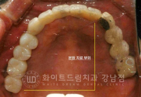 임플란트 1차 수술, 2차 수술이란 무엇일까? (+ 상악 전체 임플란트 치료 기간) 관련 이미지 13
