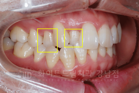 강남 덧니 비발치교정 / 임플란트와 치아교정 동시 진행 case 리뷰. 관련 이미지 7