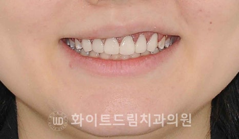 강남역 잇몸성형, 라미네이트와 흔히 동반되는 관련 이미지 11