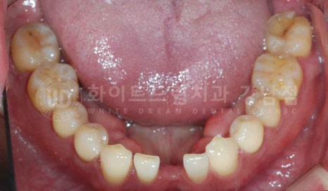 강남역 결손치 "앞니 두 개가 없고, 벌어졌어요" 결손치 치료 방법 관련 이미지 21