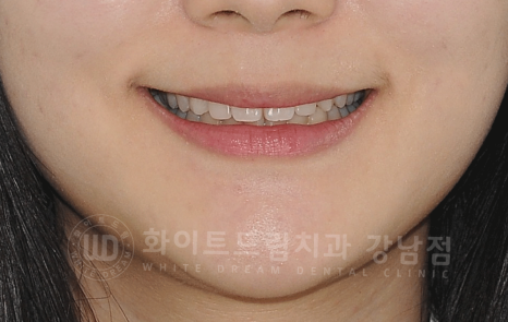 강남역 심미치과 "치아 하나가 유난히 작아요" #왜소치라미네이트 관련 이미지 12