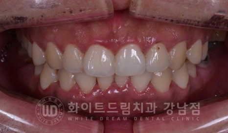 틀어진 치아 라미네이트, 틀어지고 색이 다른 앞니가 고민이에요. 관련 이미지 15