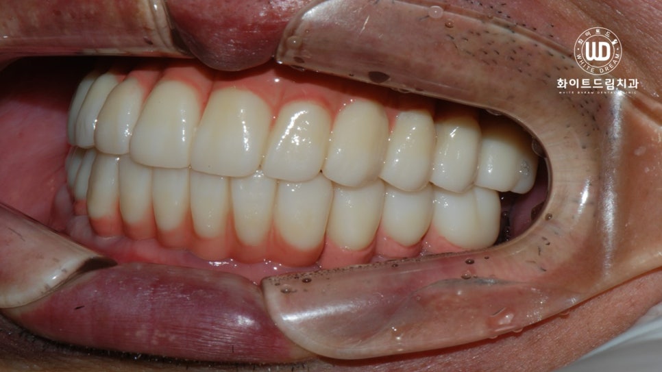 전체 치조골 이식을 동반한 고혈압 환자 임플란트 사례 관련 이미지 8