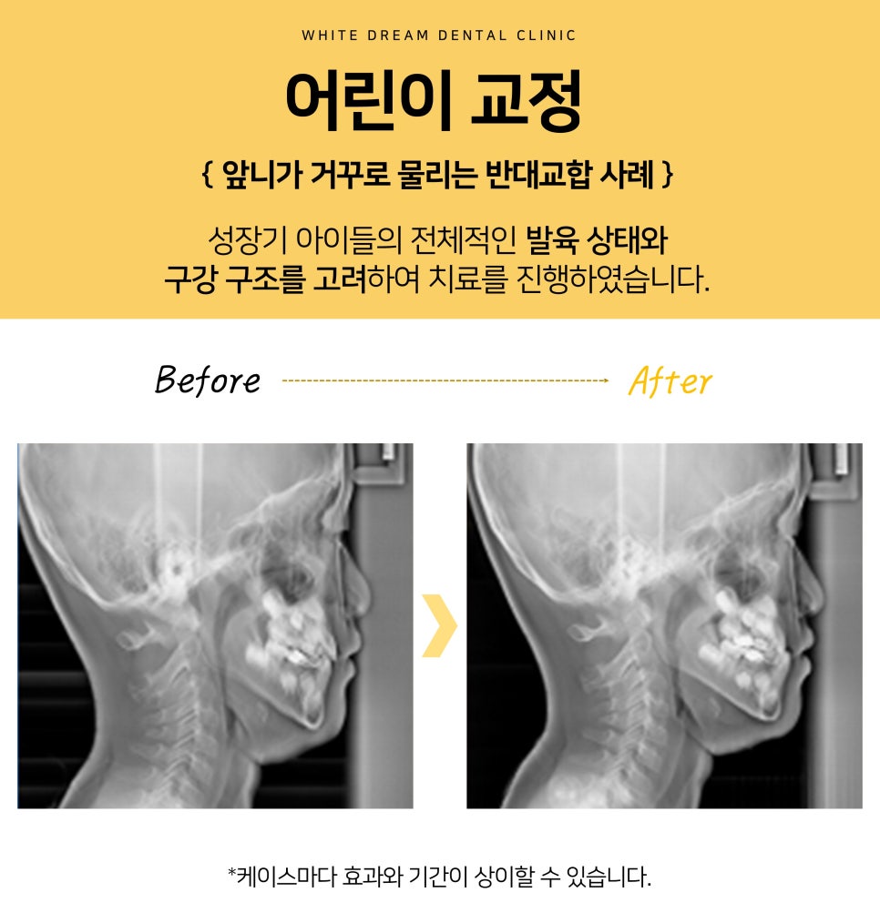 치아교정, 꼭 해야 한다면 미리 알아 두자. 관련 이미지 11