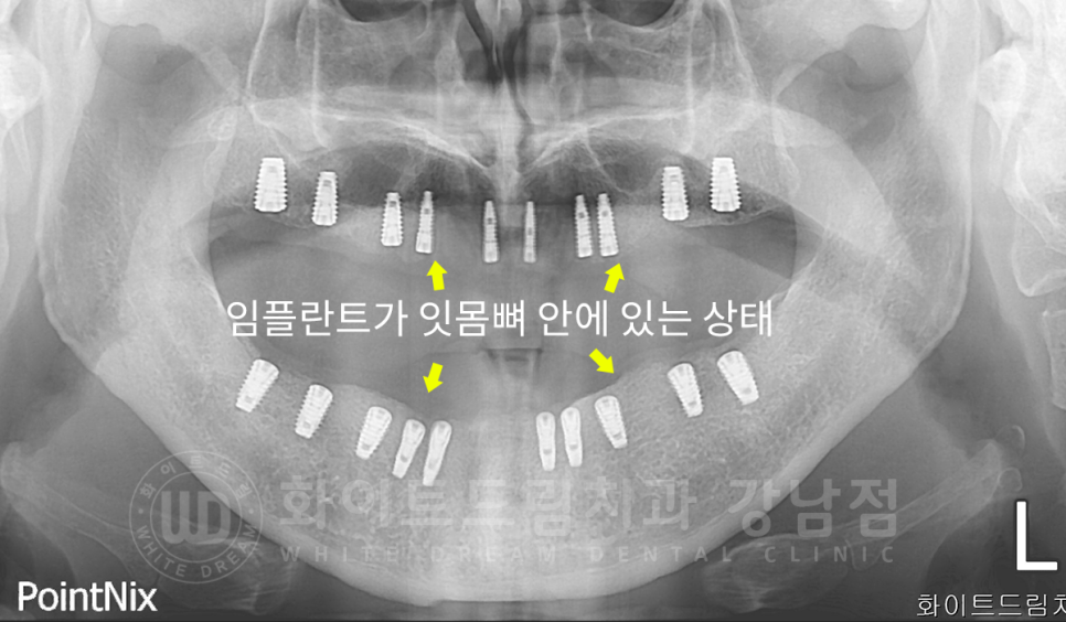 서울 전체임플란트 기간 / 전체 임플란트 7개월 완성, 무치악 임플란트 관련 이미지 10