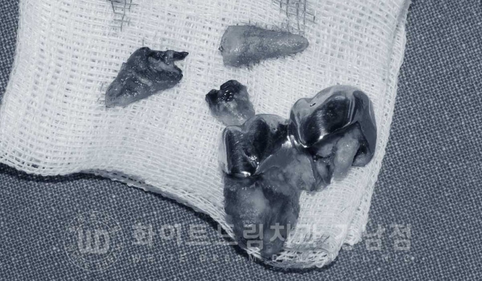 [흔들리는 어금니크라운] 흔들리고 냄새나는 오래된 크라운, 원인은? 관련 이미지 7