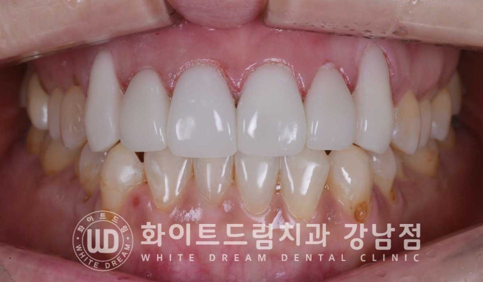 치경부착색 치료 / 라미네이트 vs 올세라믹 치아 삭제량 비교 (Feat. 라미네이트 후 치아미백 가능한가요?) 관련 이미지 9